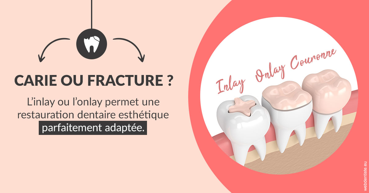 https://dr-ghadimi.chirurgiens-dentistes.fr/T2 2023 - Carie ou fracture 2