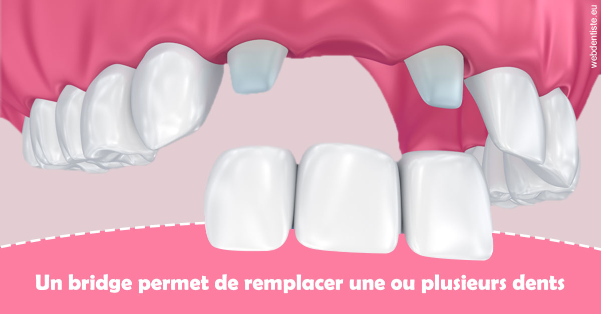 https://dr-ghadimi.chirurgiens-dentistes.fr/Bridge remplacer dents 2