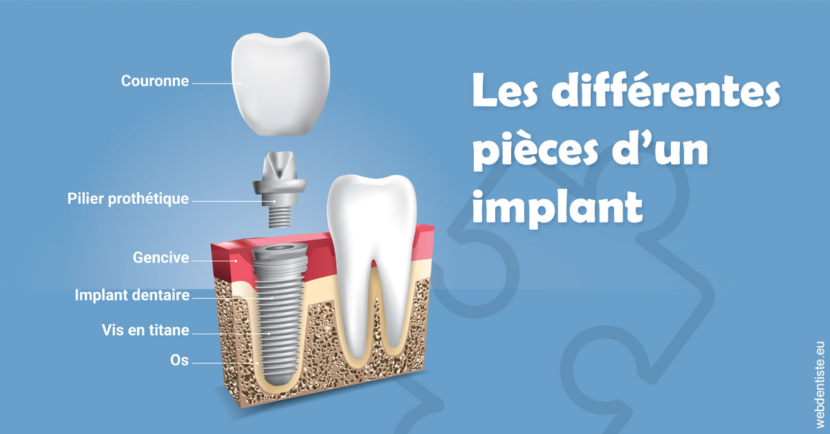 https://dr-ghadimi.chirurgiens-dentistes.fr/Les différentes pièces d’un implant 1
